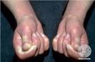 <b>Systemic Scleroderma</b>