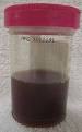 Hematuria - Wikipedia, the free encyclopedia