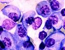 In these benign <b>plasma cells</b>