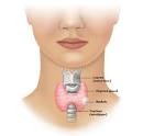 Thyroid Nodules