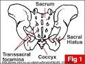 Caudal Block