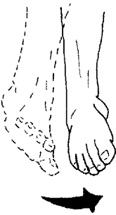 Inversion of the foot.