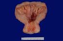 Female Genital Pathology
