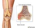Knee Bone Bruise Treatment and Diagnosis Sports Injuries Dr