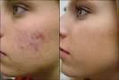 acne scars