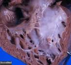 <b>Endocardial fibroelastosis</b>