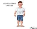 <b>Dwarfism</b>, <b>pituitary</b>.