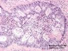 EyeRounds.org: Metastatic Choroidal Lesion from Primary ...