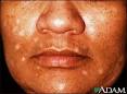 Vitiligo drug induced  MedlinePlus Medical Encyclopedia Image