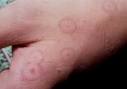 Erythema multiforme