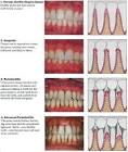 Bleeding Gums, Loose Teeth, Gum Disease, Bad Breath : Smile Concepts
