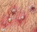 Boils on Buttocks – Causes, Pictures, Treatment and Home Remedies
