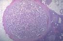 An <b>islet cell adenoma</b> is seen