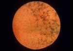 <b>retinitis</b> pigmentosa