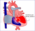 Congenital <b>Heart</b> Disease – <b>Septal Defects</b> | Medindia