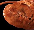 Lipoid <b>nephrosis</b>: The earliest