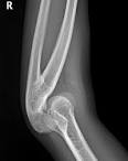 Radial Ulnar <b>Synostosis</b>