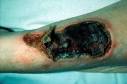Infusion Nursing |Straight Talk About IV Therapy and Vascular ...