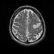 <b>Broca's aphasia</b>
