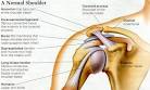 Impingement Syndrome