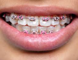 Average Cost of Braces