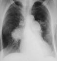 Pulmonary hypertension - Medicalook