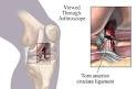 ACL - What Is The Anterior Cruciate Ligament? | ehealthMD
