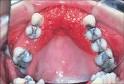 <b>Denture stomatitis</b> is a