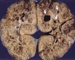 <b>Autosomal Recessive Polycystic</b>