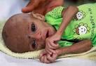 A malnourished Pakistani girl