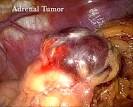 Laparoscopic Adrenal Surgery | Georgia Health Sciences Medical Center