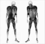 <b>Rhabdomyolysis</b> is clearly