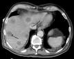Budd–Chiari syndrome - Wikipedia, the free encyclopedia