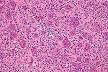 Giant-cell tumor of bone - Wikipedia, the free encyclopedia