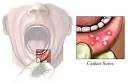Canker Sores of the Mouth: Healthwise Medical Information on ...