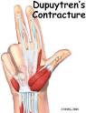<b>Dupuytren's Contracture</b>