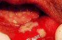 <b>Mucositis</b> is commonly seen in
