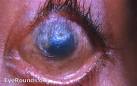Profound <b>xerophthalmia</b> due to vitamin A deficiency. EyeRounds.org