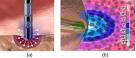 <b>Catheter Ablation</b>: (a)