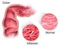 Types of Colitis