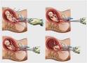 <b>Aborto</b> de un ser humano,