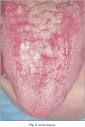 Avances en Odontoestomatología - Liquen plano oral y síndrome ...