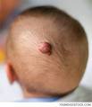 An Unofficial First-Line Treatment: Propranolol gains widespread ...