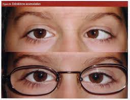Qvision Asociación del Estrabismo con Defectos Refractivos images?q=tbn:ANd9GcSVlD7kYsrUC3YOD9I6Vwx61aL sCtwt MaY19gZ v vnXE9GZ0 ArCoss