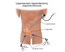 <b>Appendicitis</b>