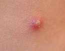 Pimples Inflammatory Lesions|Causes/Precautions Pimples