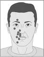 Trigeminal <b>neuralgia</b>:
