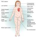 Turner Syndrome Causes, Symptoms And Karyotypes