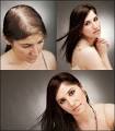Hair Replacement | Women's Hair Loss Project