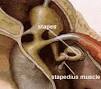 Hyperacusis